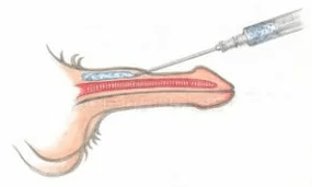 Hyaluronic acid injections